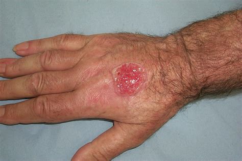 Wide Excision Of A Squamous Cell Carcinoma Similar To This On The Hand