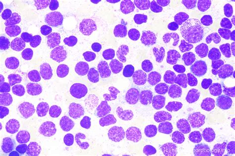 Mantle Cell Lymphoma Mcl Hematomorphology A Databank Imagebank