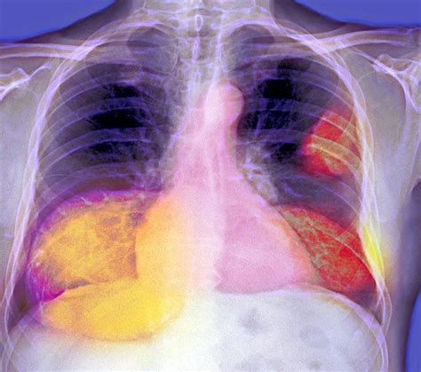 Lung Cancer X Ray Photograph By Du Cane Medical Imaging Ltd Pixels