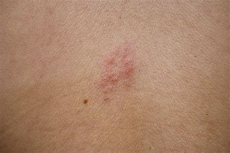 10 Signs Of Shingles Facty Health