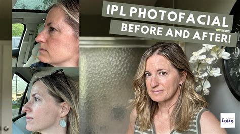 Ipl Photofacial Before And After Is It Worth It Youtube