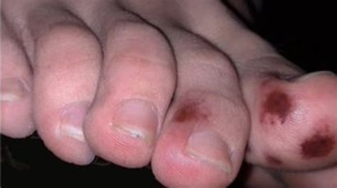 ‘covid Toes Mystery Skin Rash Could Be Symptom Of Coronavirus The