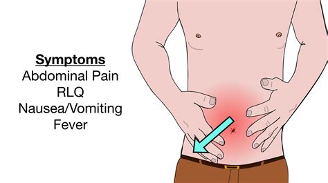 Appendicitis Pain Symptoms Signs Causes Diagnosis Treatment EZmed