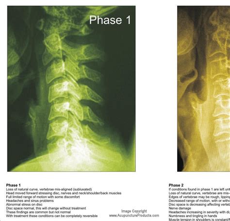 Phases Spinal Degeneration Cervical Spine Poster 24 X 36 Chiropractic Chart