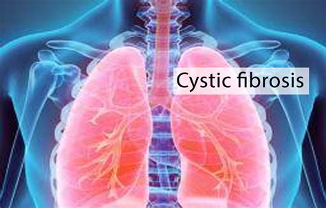 Cystic Fibrosis Pictures