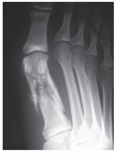 Keys To Treating Proximal Fifth Metatarsal Fractures Hot Sex Picture