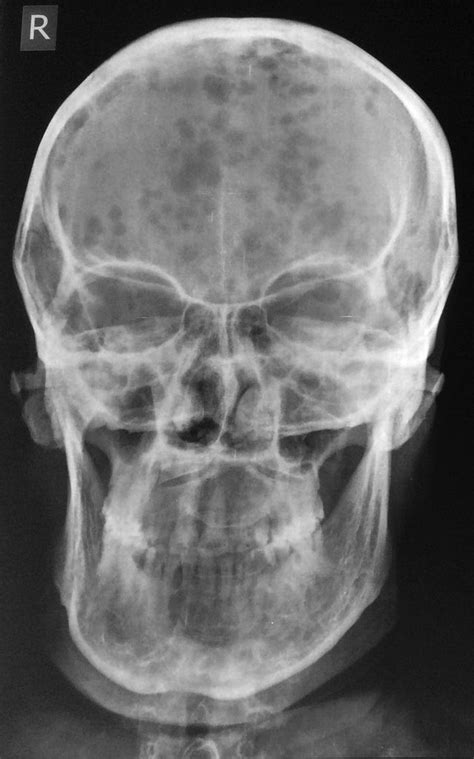 Multiple myeloma is a blood cancer affecting the plasma cells of the bone marrow. Multiple myeloma | Radiology Case | Radiopaedia.org ...