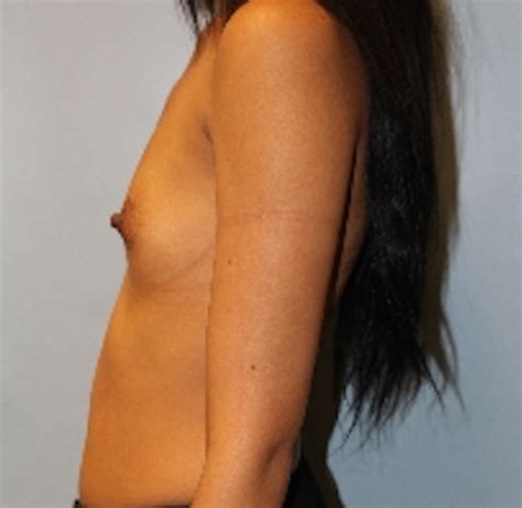 946 Breast Augmentation Before And After Photos Las Vegas Cosmetic