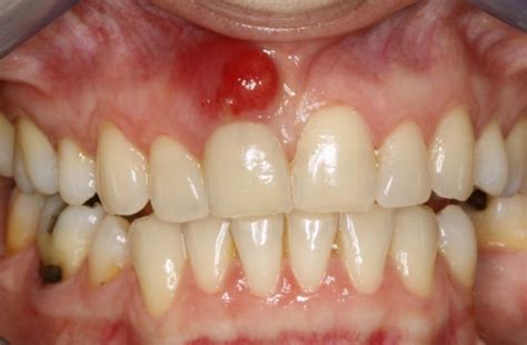 Infected Tooth Extraction Symptoms Treatment Causes Pictures