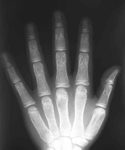 A Plain X Ray Right Hand Ap B Magnified View For Proximal