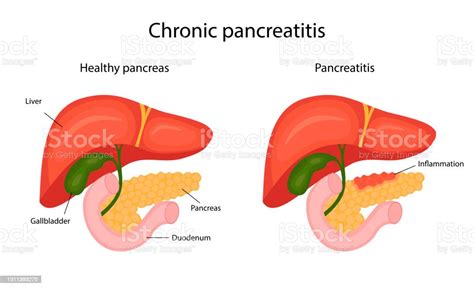 Disease Pancreatitis Infographic Liver And Pancreas Vector Illustration