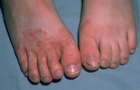 Suitable Foot Fungus Treatments