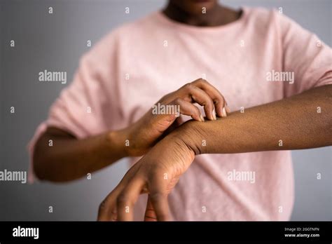 African American Woman With Itchy Skin Allergy Or Psoriasis Stock