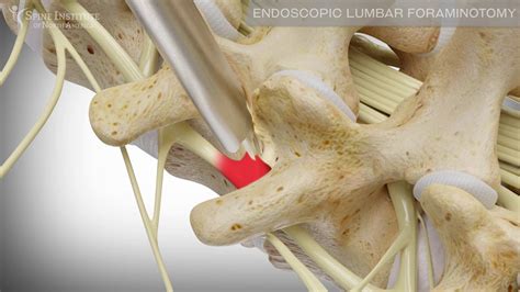 Endoscopic Lumbar Foraminotomy Spine Institute Of North America Youtube