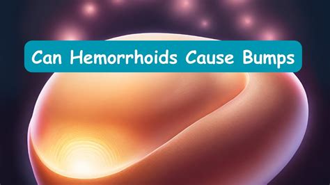 Can Hemorrhoids Cause Bumps YouTube