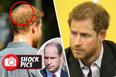 Prince Harry Hair Loss Pics Show Royal Will Soon Be As Bald As Brother