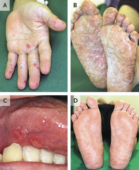 Hand Foot And Mouth Disease Skin Peeling