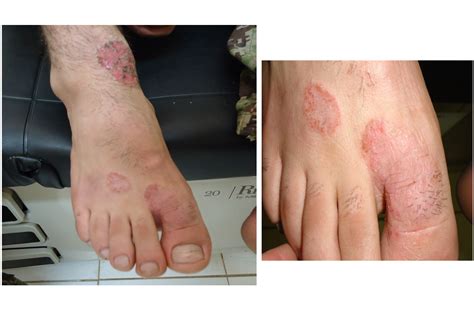 Tinea Pedis International Journal Of Clinical And Medical Images