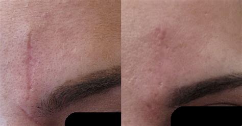 Scar Removal Rf Microneedling And Laser Treatments Miami Skin Spa