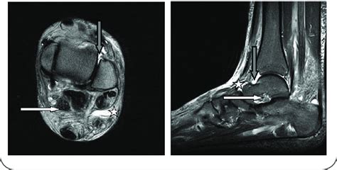 Tibial Nerve Mri