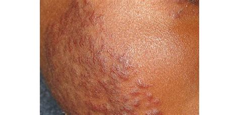 Discoid Lupus Erythematosus Symptoms And Treatment Autoimmune