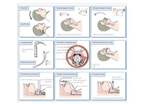 Airway Management And Sedation Airway Management In The Emergency