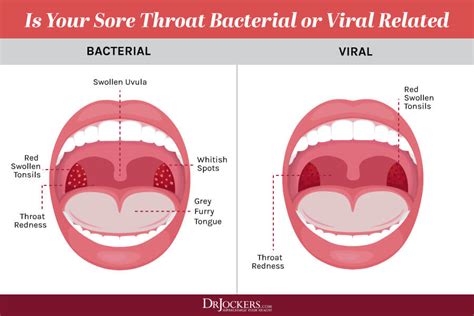 Acid Reflux Sore Throat And Ears Release What Glands Acidreflux