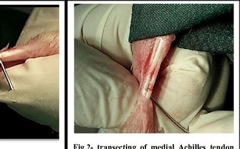 Symptoms include pain, stiffness and even a bone spur. Medial and lateral portion of the Achilles tendon and the ...