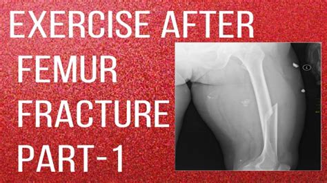 Exercise After Femur Fracture Part 1 Thigh Bone Fracture