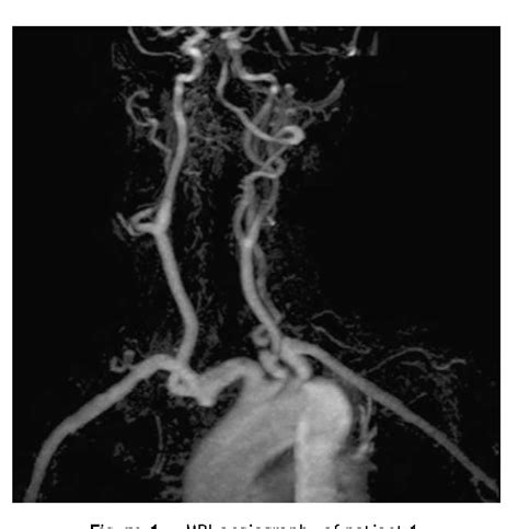 Figure 1 From High Riding Innominate Artery In Neck Surgery Semantic