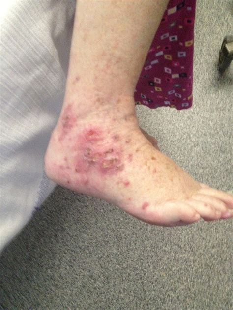 Photograph Of The Right Ankle And Foot Showing An Erythematous Papular