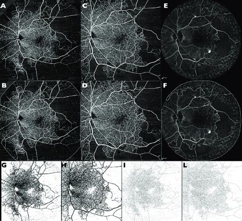 Swept Source Optical Coherence Tomography Angiography SS OCTA And