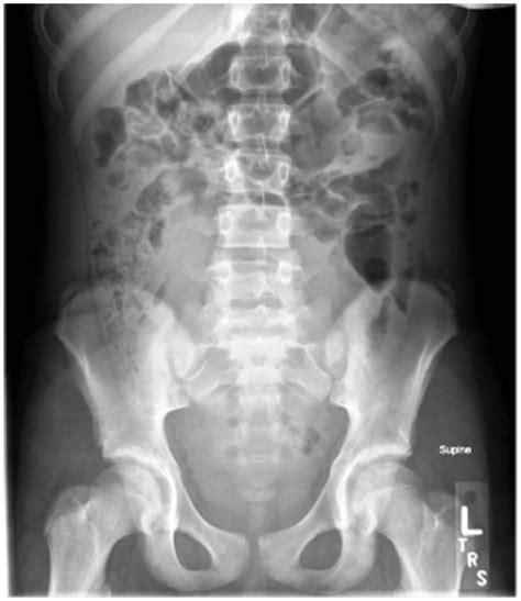 Transabdominal Ultrasound Midsagittal Image Of Pelvis Demonstrates A