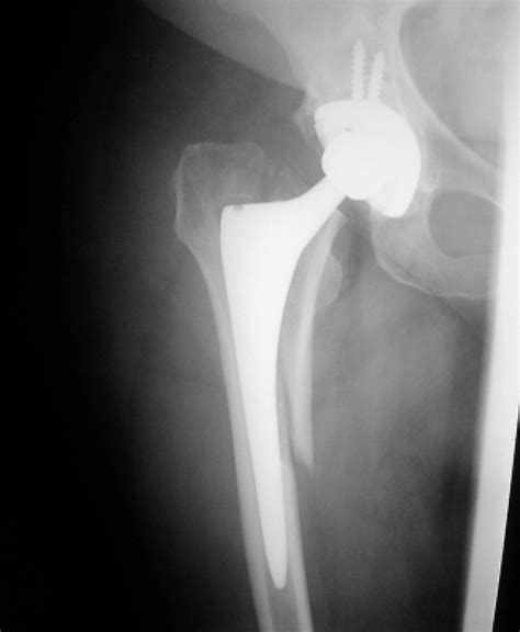 Figure 1 From Total Hip Arthroplasty Periprosthetic Femoral Fractures