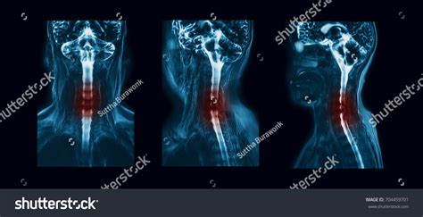 Mr Magnetic Resonance Myelography Myelogram Cervical Stock Photo