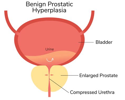 How An Enlarged Prostate Affects Your Sexual Health Menmd
