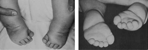 Persistent Clubfoot Deformity Following Treatment By The Pon