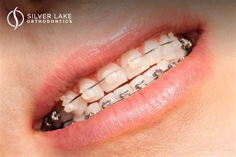 all about dental braces everett silverlake orthodontics
