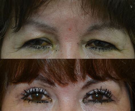 Upper Eyelid Surgery Blepharoplasty Before And After Photos Fresh Face