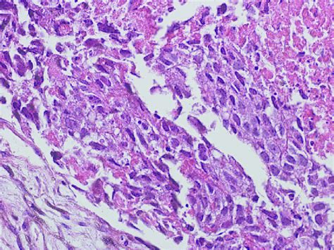 Large Acidophilic Cytoplasm Of Tumor Cells Of Old Lung Biopsy Hande