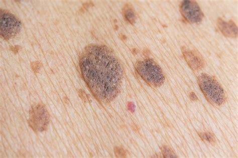 Can Freckles Bleed Exploring Types Causes Risks And Treatments