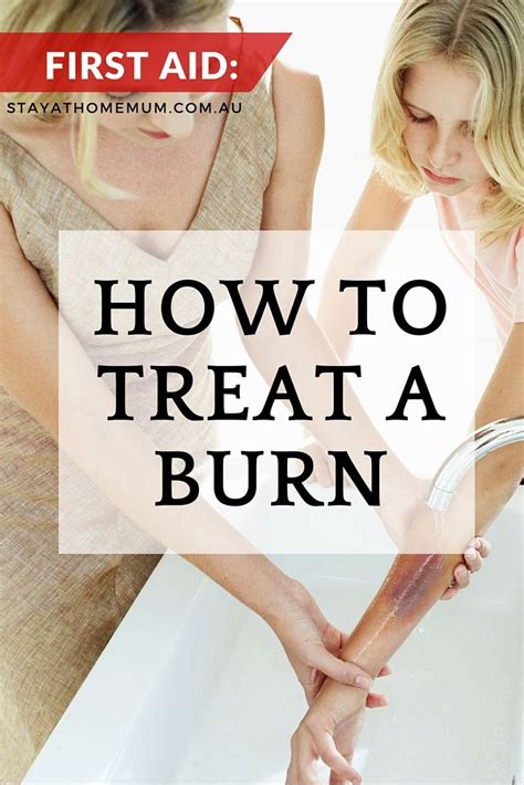 How To Treat A Burn Stay At Home Mum Homeremedy Remedy