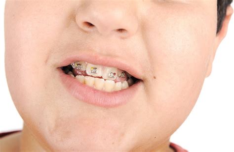 5 Signs Your Child Needs Braces