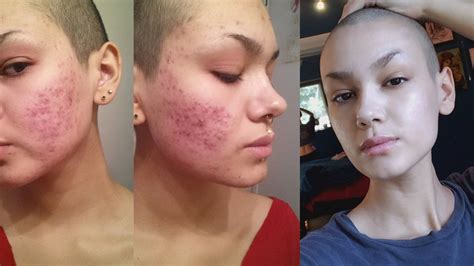 How I Cured My Severe Hormonal Acne Naturally Updated Youtube