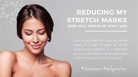 17 Reasons You Should Treat Your Stretch Marks
