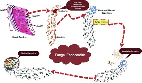 E Pathogenesis Of Fungal Endocarditis Different Stages Of Fungal