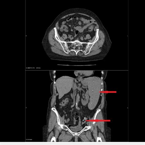 Computed Tomography Scan Abdomen And Pelvis With Intravenous Contrast
