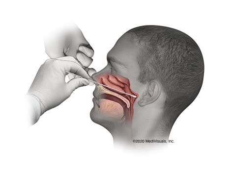 Avoiding contact with external nasal skin, insert the swab along the medial part of the septum, along the base of the nose (gently rotating the. Coronavirus: Unpleasant nasal swab test image goes viral ...