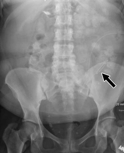 Peritoneal Dialysis Catheter X Ray