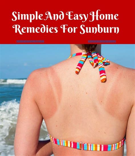 Simple And Easy Home Remedies For Sunburn Sunburn Remedies Home